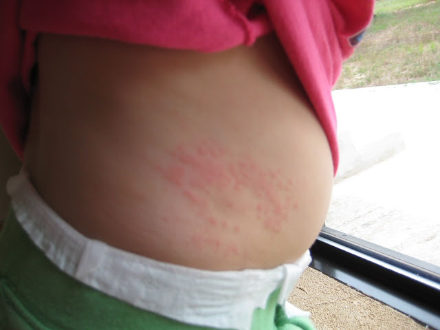 Mystery Rash BabyCenter